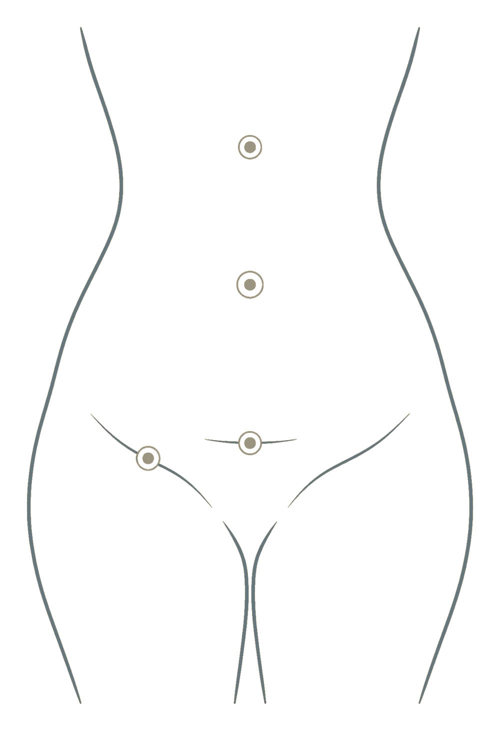 Desenho do abdome com os quatro pontos onde a hérnia costuma aparecer: acima do umbigo, no umbigo, na cicatriz e na virilha