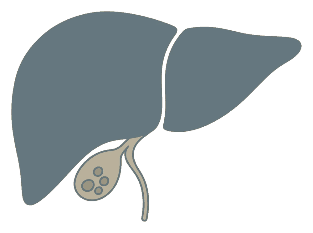 Desenho do fígado com a vesícula logo abaixo, com pedras dentro